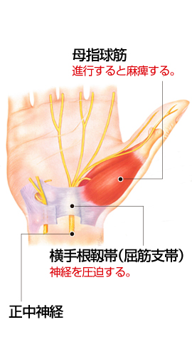 手根幹症候群　説明図