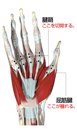 ばね指　説明図